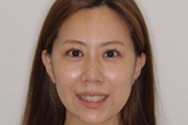 【モニター】歯列が狭くデコボコが気になる　急速拡大装置を用いたインビザライン矯正 治療前画像