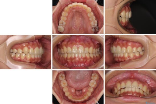 【モニター】歯列が狭くデコボコが気になる　急速拡大装置を用いたインビザライン矯正 治療後画像