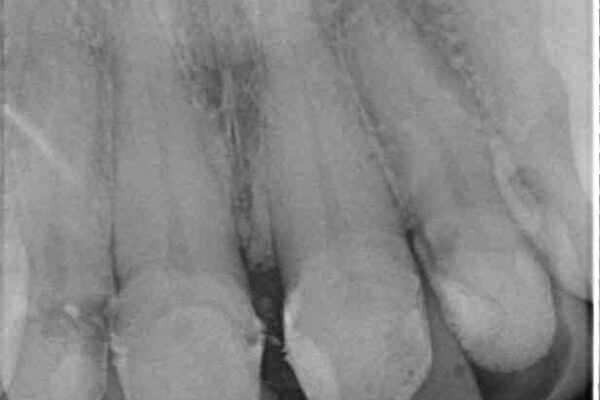 ひどすぎる前歯の仮歯　オールセラミッククラウンで自然な前歯に 治療前画像