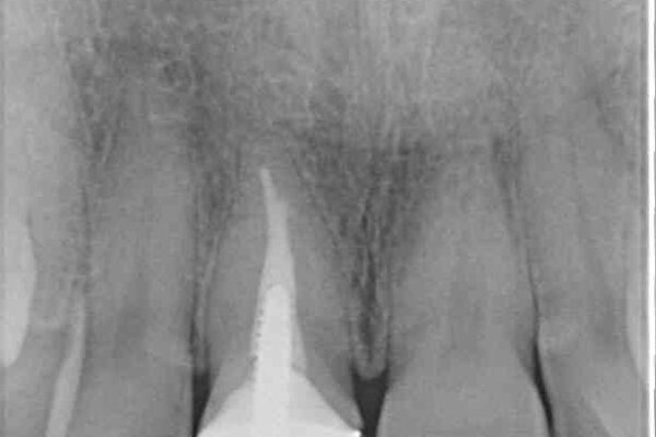 白すぎる前歯と虫歯の奥歯　セラミック治療 治療前画像