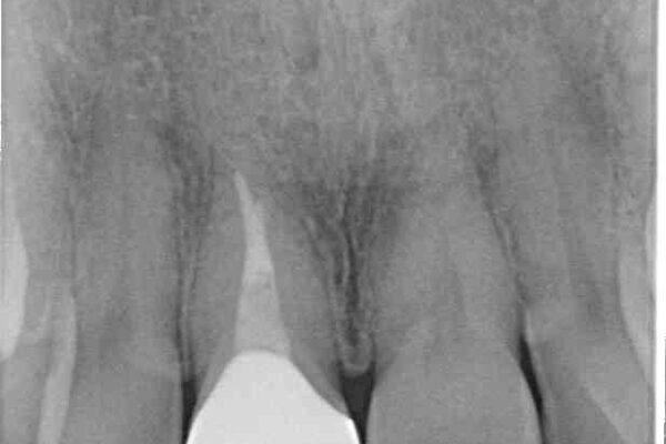 白すぎる前歯と虫歯の奥歯　セラミック治療 治療後画像