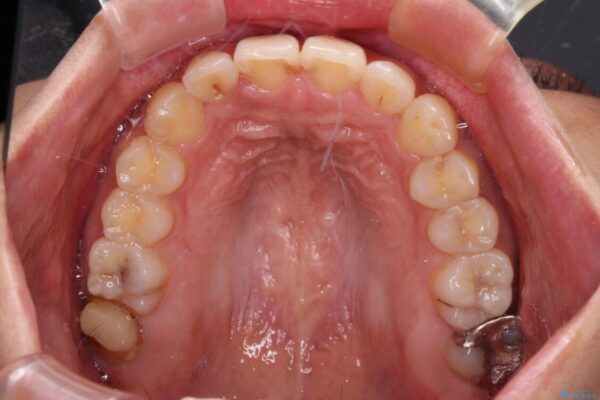 【モニター】歯列が狭くデコボコが気になる　急速拡大装置を用いたインビザライン矯正 治療途中画像