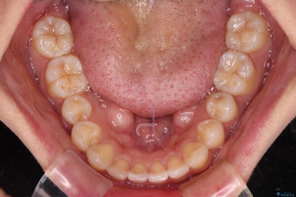 【モニター】歯列が狭くデコボコが気になる　急速拡大装置を用いたインビザライン矯正 治療途中画像