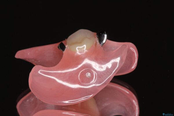 折れてしまった奥歯　装着感の良い入れ歯治療 治療後画像