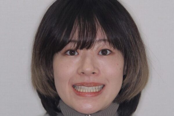 【モニター】狭い上顎歯列とオープンバイト　急速拡大装置を用いた矯正治療 治療後画像