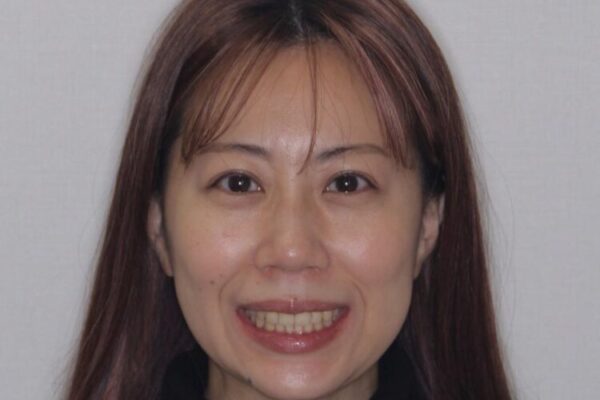 【モニター】歯列が狭くデコボコが気になる　急速拡大装置を用いたインビザライン矯正 治療後画像