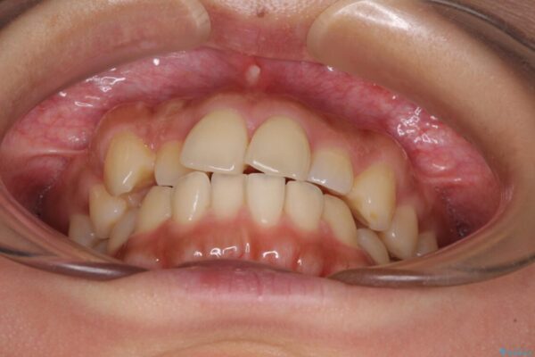 【モニター】歯列が狭くデコボコが気になる　急速拡大装置を用いたインビザライン矯正 治療前画像