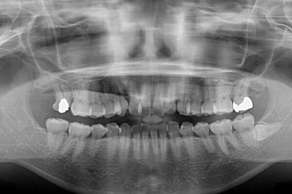 【モニター】歯列が狭くデコボコが気になる　急速拡大装置を用いたインビザライン矯正 治療前画像