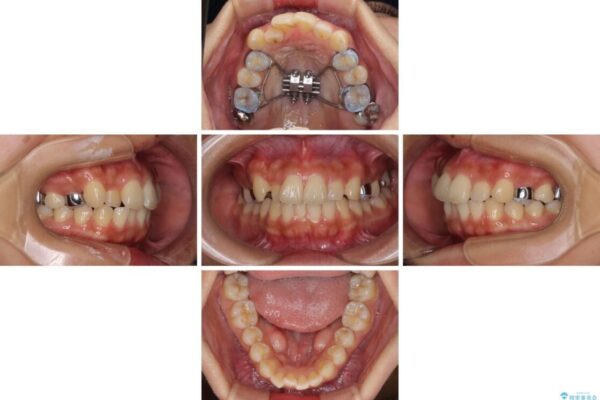 【モニター】歯列が狭くデコボコが気になる　急速拡大装置を用いたインビザライン矯正 治療途中画像