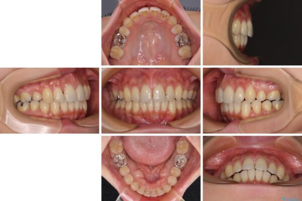 上顎前歯の突出を軽減　インビザラインによる抜歯矯正 治療途中画像
