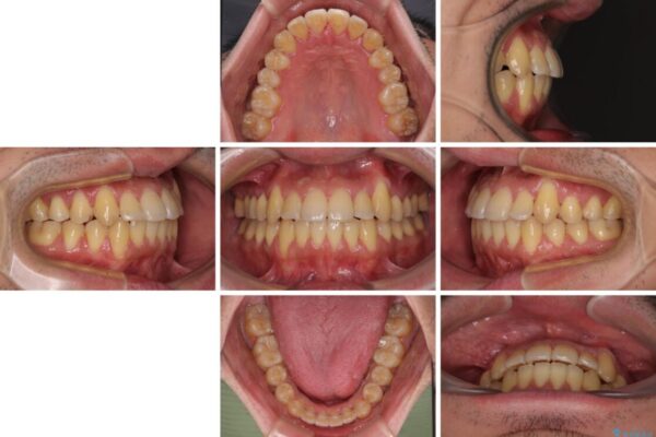 八重歯とクロスバイト　目立たないワイヤー装置で矯正治療 治療後画像