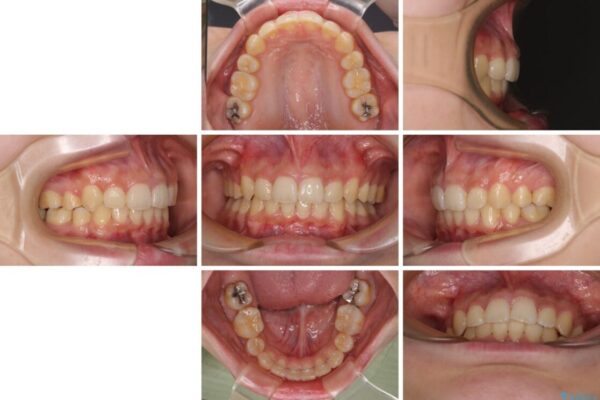 下顎前歯が隠れて突出した口元　ワイヤー装置での抜歯矯正 治療後画像
