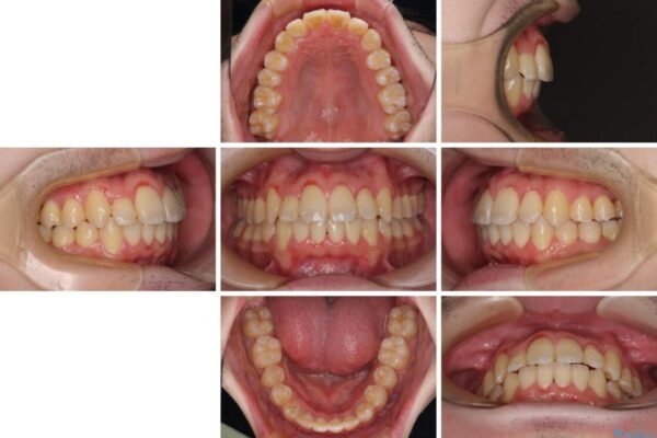 全顎的なクロスバイト　補助装置を用いてワイヤー矯正 治療後画像