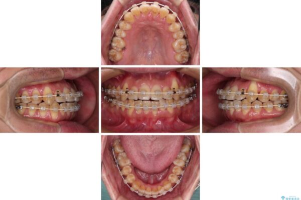 八重歯とクロスバイト　目立たないワイヤー装置で矯正治療 治療途中画像