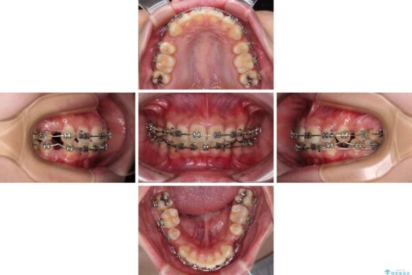 下顎前歯が隠れて突出した口元　ワイヤー装置での抜歯矯正 治療途中画像