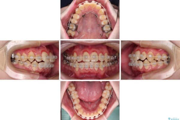 全顎的なクロスバイト　補助装置を用いてワイヤー矯正 治療途中画像