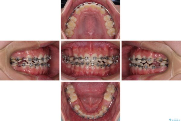 口元の突出感を改善　受け口傾向の咬み合わせの抜歯矯正 治療途中画像