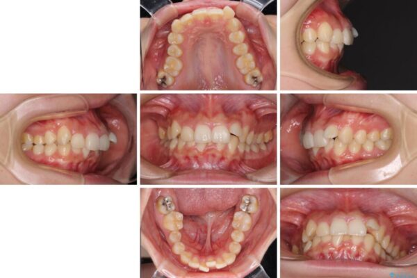 下顎前歯が隠れて突出した口元　ワイヤー装置での抜歯矯正 治療前画像