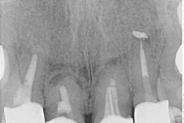 仮歯のまま放置した前歯　オールセラミッククラウンで自然な前歯に 治療後画像