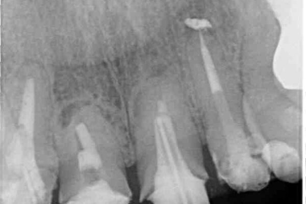 仮歯のまま放置した前歯　オールセラミッククラウンで自然な前歯に 治療前画像