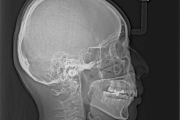 上顎前歯の突出を軽減　インビザラインによる抜歯矯正 治療後画像