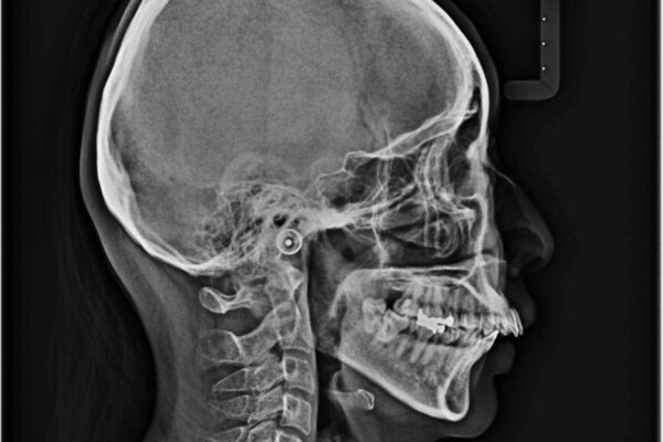 上顎前歯の突出を軽減　インビザラインによる抜歯矯正 治療前画像