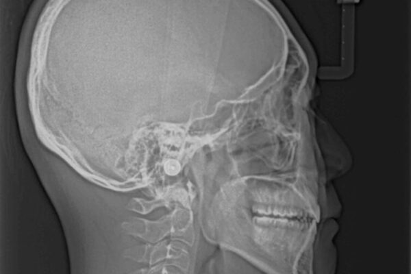 口元の突出感を改善　受け口傾向の咬み合わせの抜歯矯正 治療後画像