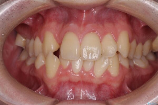 全顎的なクロスバイト　補助装置を用いてワイヤー矯正 ビフォー