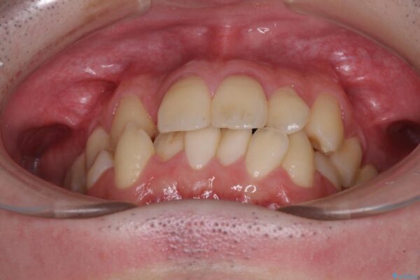 全顎的なクロスバイト　補助装置を用いてワイヤー矯正 治療前画像