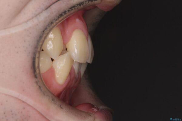 全顎的なクロスバイト　補助装置を用いてワイヤー矯正 治療前画像