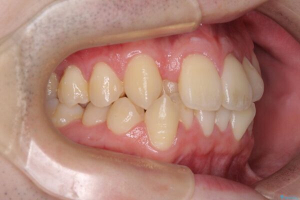 全顎的なクロスバイト　補助装置を用いてワイヤー矯正 治療前画像