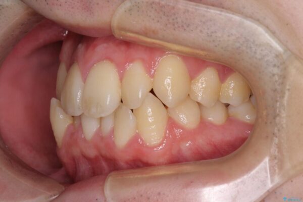 全顎的なクロスバイト　補助装置を用いてワイヤー矯正 治療前画像