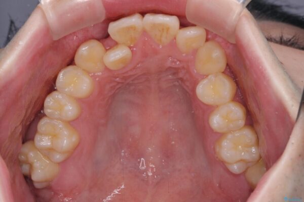 全顎的なクロスバイト　補助装置を用いてワイヤー矯正 治療前画像