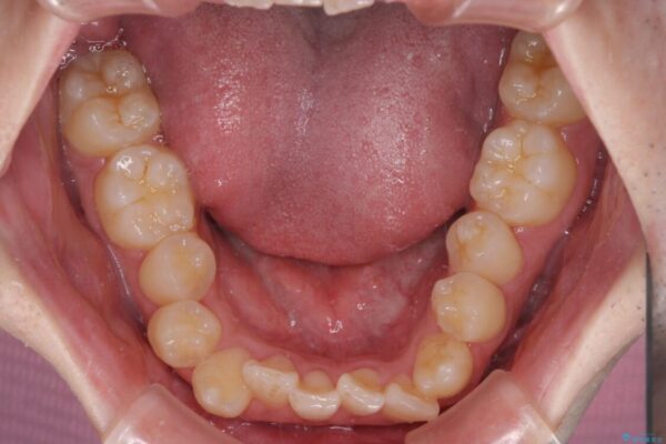 全顎的なクロスバイト　補助装置を用いてワイヤー矯正 治療前画像