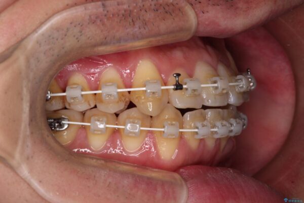 八重歯とクロスバイト　目立たないワイヤー装置で矯正治療 治療途中画像