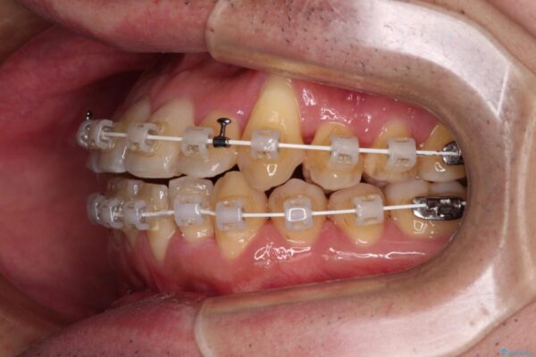 八重歯とクロスバイト　目立たないワイヤー装置で矯正治療 治療途中画像