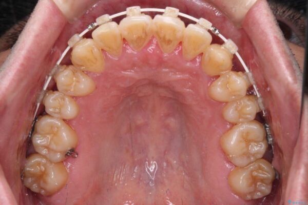 八重歯とクロスバイト　目立たないワイヤー装置で矯正治療 治療途中画像