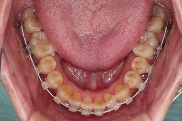 八重歯とクロスバイト　目立たないワイヤー装置で矯正治療 治療途中画像