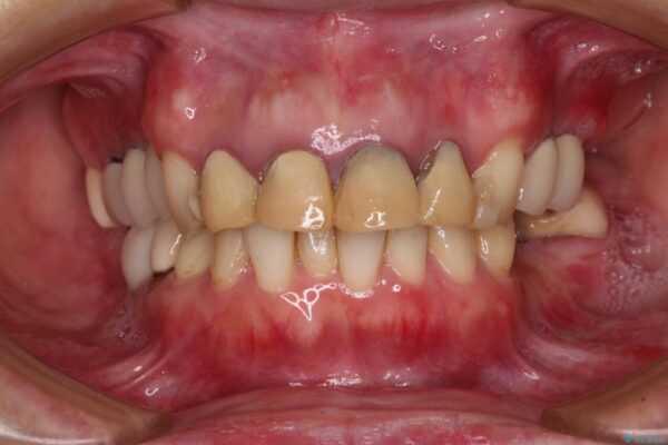 仮歯のまま放置した前歯　オールセラミッククラウンで自然な前歯に 治療前画像