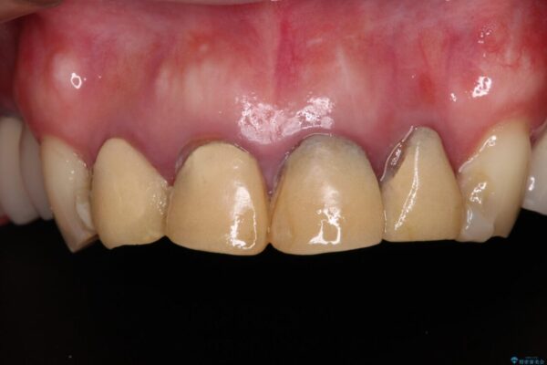 仮歯のまま放置した前歯　オールセラミッククラウンで自然な前歯に ビフォー