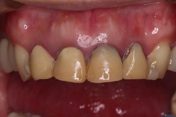 仮歯のまま放置した前歯　オールセラミッククラウンで自然な前歯に 治療前画像