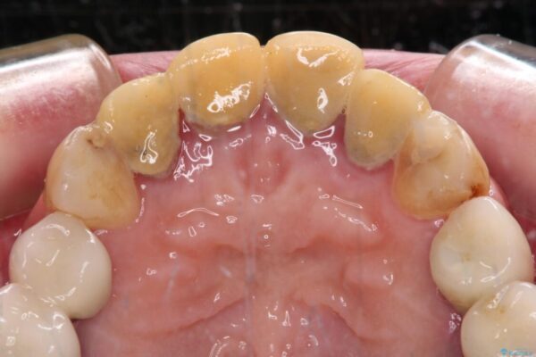 仮歯のまま放置した前歯　オールセラミッククラウンで自然な前歯に 治療前画像