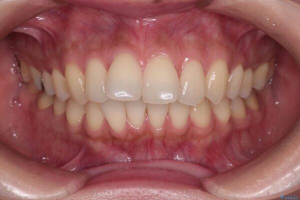 上顎前歯の突出を軽減　インビザラインによる抜歯矯正 治療前画像