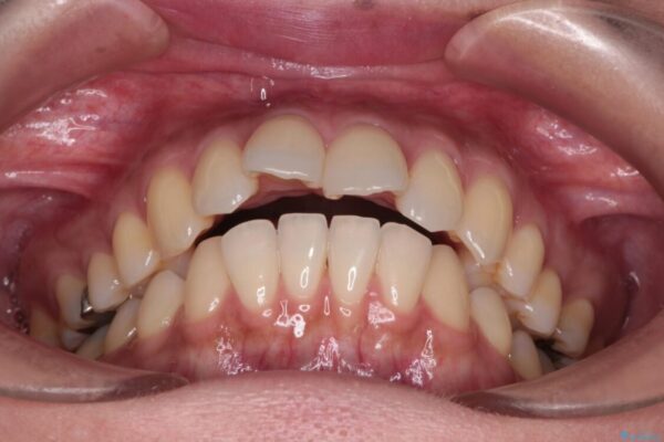 上顎前歯の突出を軽減　インビザラインによる抜歯矯正 治療前画像