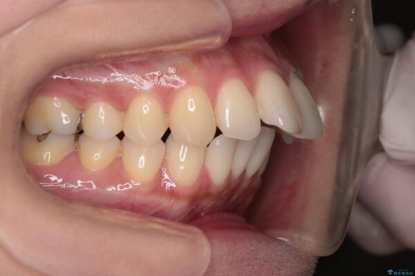 上顎前歯の突出を軽減　インビザラインによる抜歯矯正 ビフォー