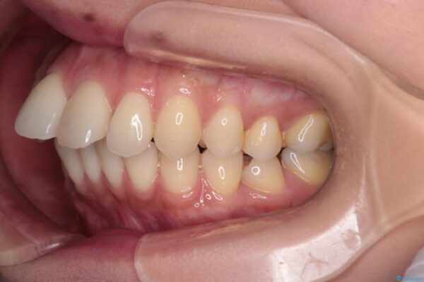 上顎前歯の突出を軽減　インビザラインによる抜歯矯正 治療前画像