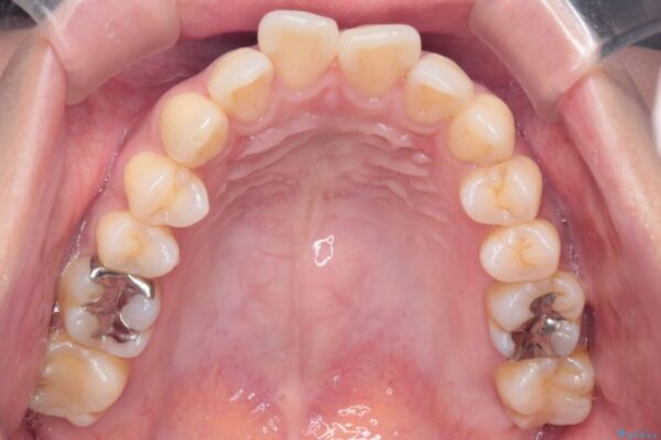 上顎前歯の突出を軽減　インビザラインによる抜歯矯正 治療前画像