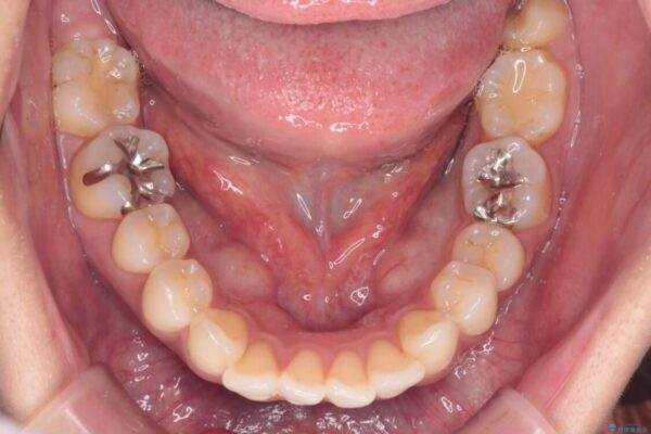 上顎前歯の突出を軽減　インビザラインによる抜歯矯正 治療前画像