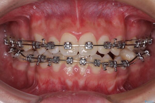 口元の突出感を改善　受け口傾向の咬み合わせの抜歯矯正 治療途中画像