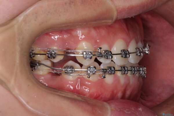口元の突出感を改善　受け口傾向の咬み合わせの抜歯矯正 治療途中画像